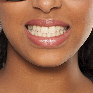 Photo of a person showing their teeth